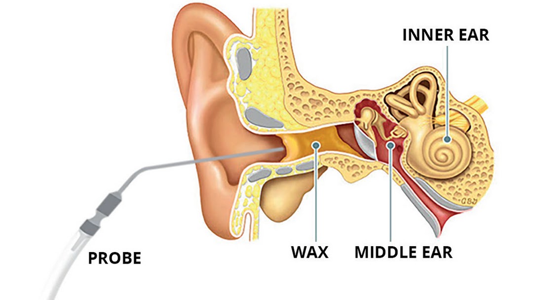 جراحی اندوسکوپیک گوش