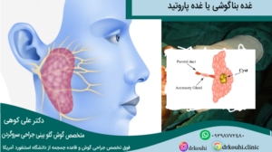 غده پاروتید