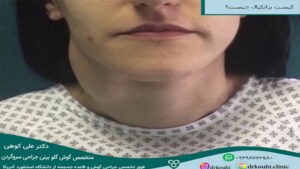 کیست برانکیال