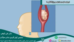 درمان تومور پاراگانگلیوما