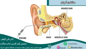ساکشن گوش؛ علائم، روند انجام، مزایا و عوارض ساکشن گوش