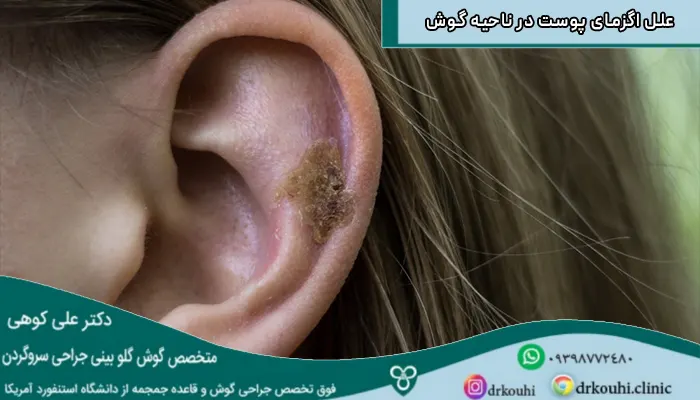 علل اگزمای پوست در ناحیه گوش