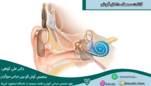 کاشت سمعک داخل گوش