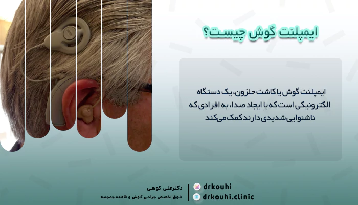 تعریف ایمپلنت گوش (Implantable Hearing Devices)