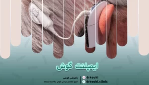 ایمپلنت گوش چیست؟ | انواع و مزایا کاشت ایمپلنت گوش