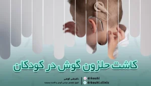 کاشت حلزون گوش در کودکان