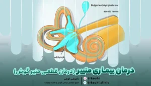 درمان منییر