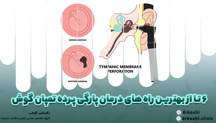 بهترین درمان برای پارگی پرده گوش