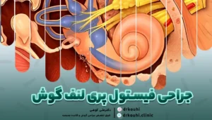 تصویری از شرایط ترمیم فیستول گوش