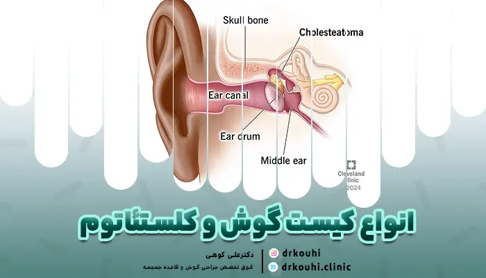 انواع کیست گوش و کلستئاتوم | انواع کلستاتوم گوش چیست؟