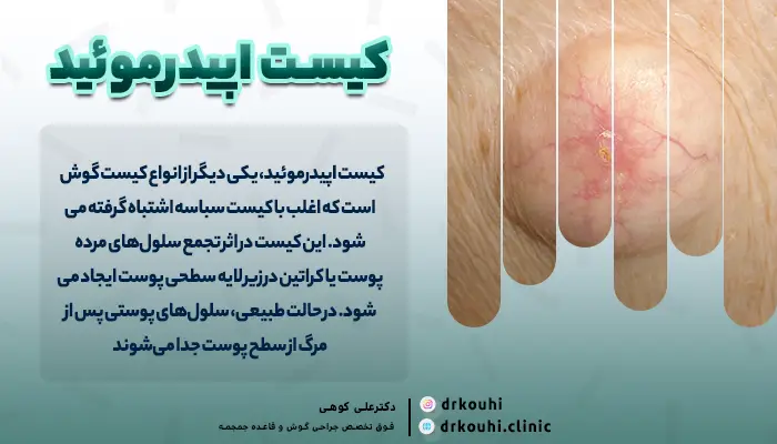 کیست گوش اپیدرموئید