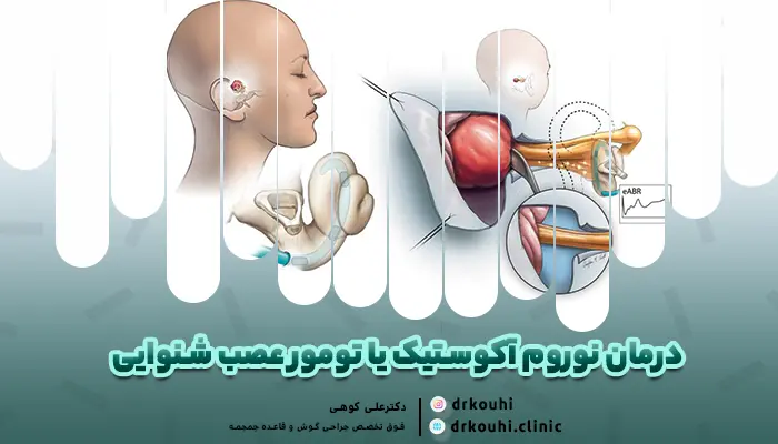 تصویری از وضعیت آکوستیک نوروم و جراحی آن