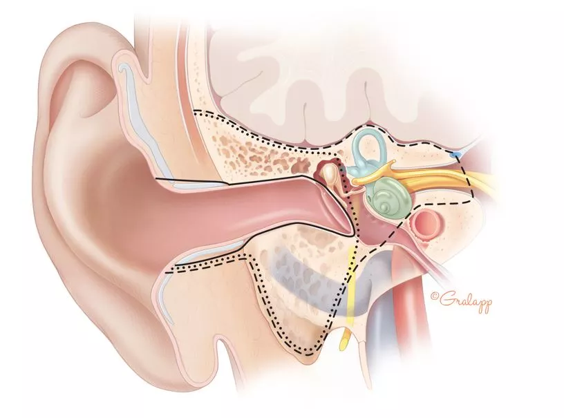 جراحی استخوان گیجگاهی | جراحی استخوان تمپورال