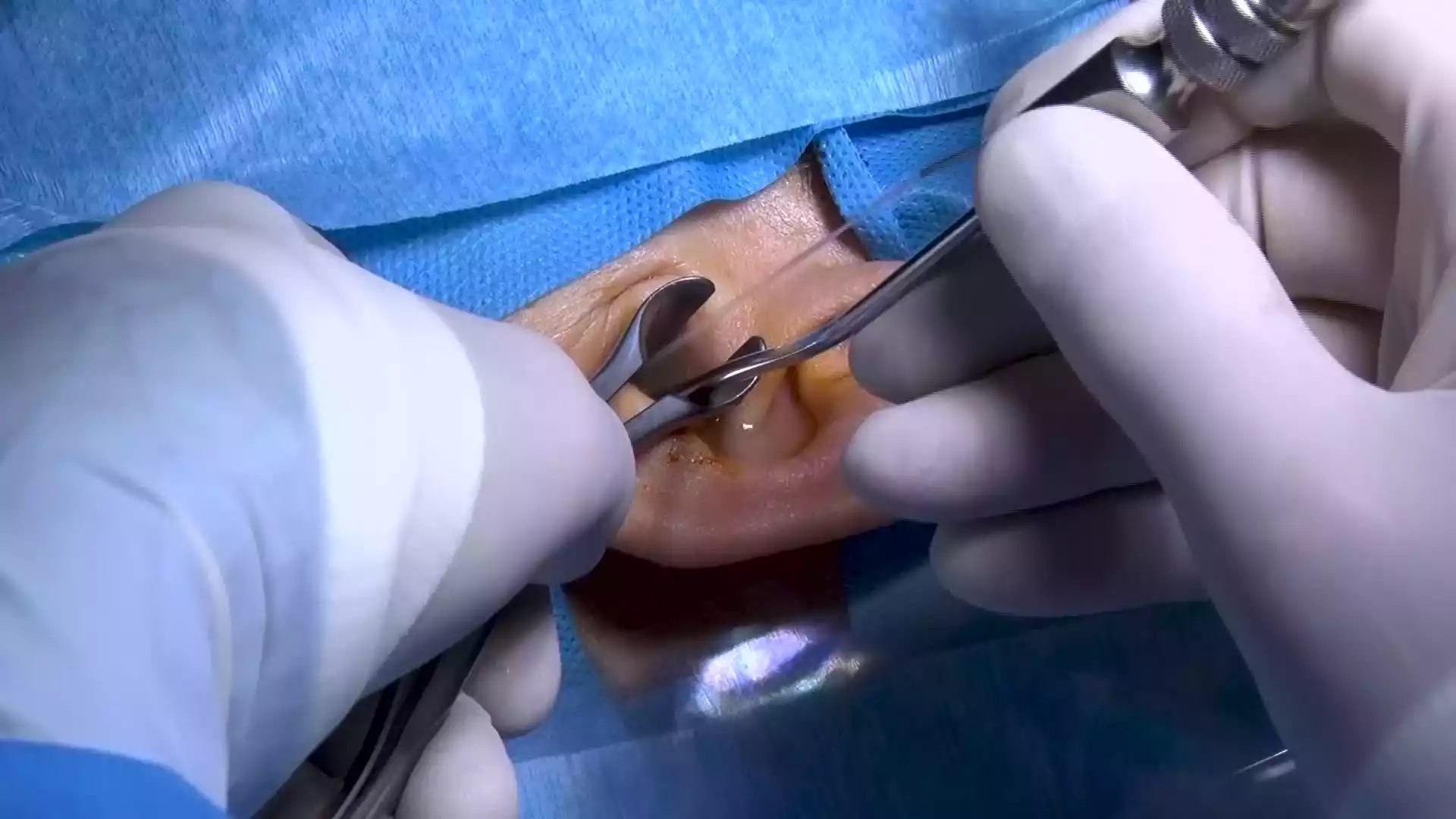 عمل جراحی اندوسکوپیک گوش چیست؟