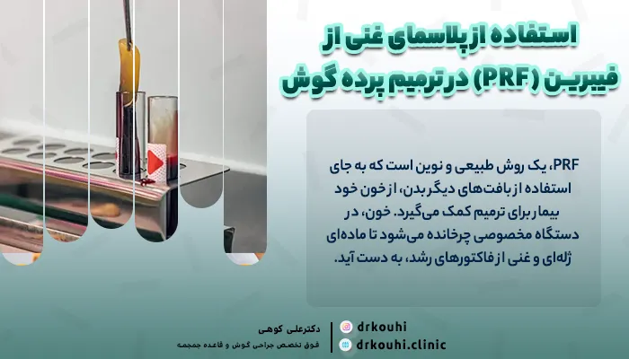 استفاده از پلاسمای غنی از فیبرین (PRF) در ترمیم پرده گوش