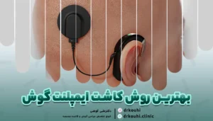 بهترین روش کاشت ایمپلنت گوش: عمل کاشت ایمپلنت حلزون گوش در ایران
