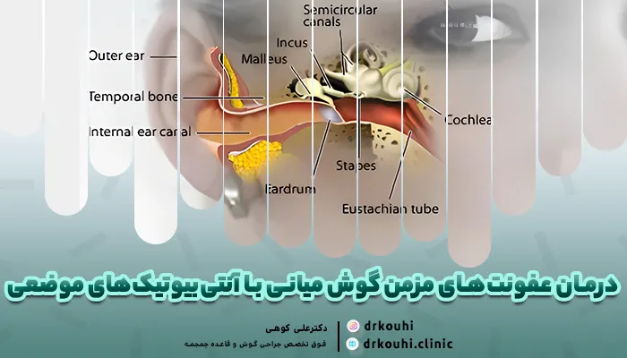 درمان عفونت مزمن گوش میانی با آنتی بیوتیک موضعی گوش
