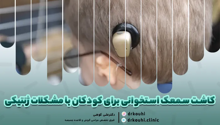 کاشت سمعک استخوانی برای کودکان با مشکلات ژنتیکی