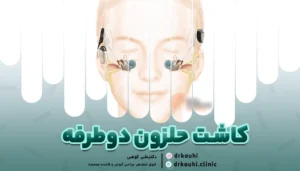 کاشت حلزون دوطرفه: مزایا برای بهبود شنوایی استریو