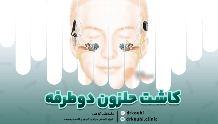 کاشت حلزون دوطرفه: مزایا برای بهبود شنوایی استریو