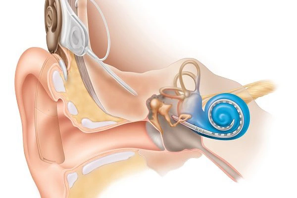 قیمت عمل ماستوئیدکتومی؛ راهنمای جامع هزینه جراحی گوش ماستوئیدکتومی | هزینه عمل ماستوئیدکتومی
