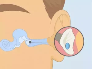 آیا تکان خوردن مایع گوش خطرناک است؟ علل و درمان