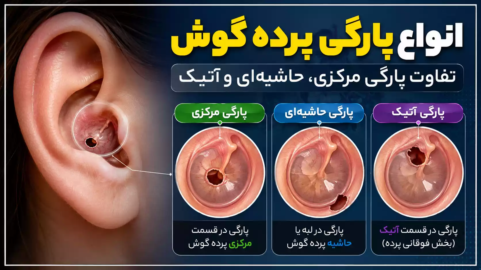 انواع پارگی پرده گوش | تفاوت پارگی مرکزی، حاشیه‌ای و آتیک